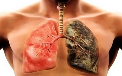 DAÑO PULMONAR POR COCKTAIL CAUSTICO