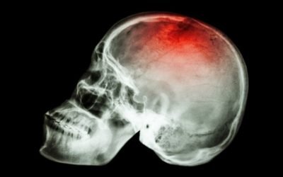 OHB EN PACIENTES CON TRAUMA CEREBRAL SEVERO