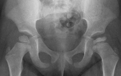 APLICACIÓN DE LA MEDICINA HIPERBÁRICA EN EL MANEJO DEL LEGG-CALVÉ- PERTHES