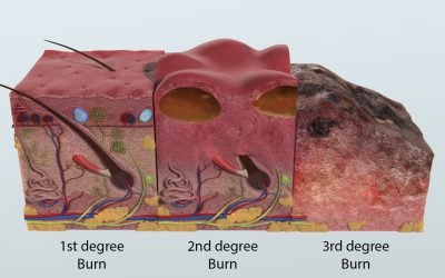 HYPERBARIC OXYGEN THERAPY FOR THE TREATMENT OF SECOND AND THIRD DEGREE BURNS