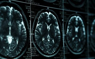 OHB EN EL SINDROME FRONTAL SUBCORTICAL POR ENFERMEDAD DE PEQUEÑAS ARTERIAS CON LEUCOARAIOSIS