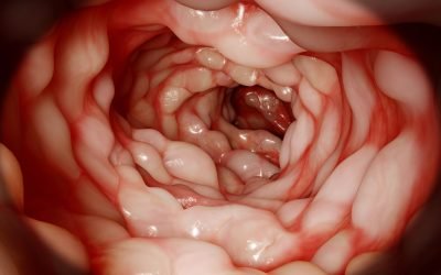 HYPERBARIC OXYGEN THERAPY IN CROHN´S DISEASE AND ULCERATIVE COLITIS
