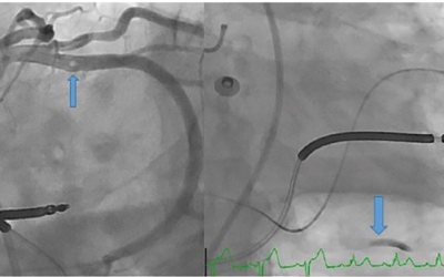 OHB Y FISIOPATOLOGIA DEL EMBOLISMO GASEOSO