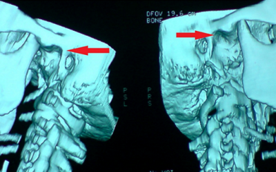 PATOLOGIAS DE LA ARTICULACIÓN TEMPOROMANDIBULAR EN EL BUCEO