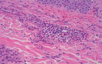 UNA VASCULITIS LEUCOCITOCLÁSTICA TRATADA CON ÉXITO CON OXÍGENO HIPERBÁRICO: INFORME DE CASO