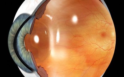 INVESTIGACION DEL USO DE LA OHB COMO MODALIDAD PRIMARIA DE TRATAMIENTO DEL EDEMA MACULAR DIABETICO ( EMD )