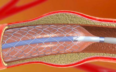 ¿Qué son los stents y para qué se utilizan en cardiología?